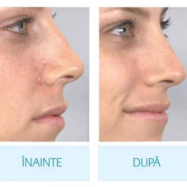 Aspirator de Curatare Faciala
