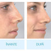 Aspirator de Curatare Faciala